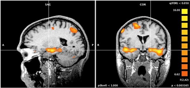 Brain changes with cognitive behavioral therapy